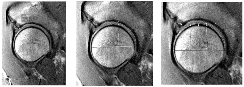 Quantitative Magnetic Resonance Imaging and Patient-Reported Outcomes in Patients Undergoing Hip Labral Repair or Reconstruction.
