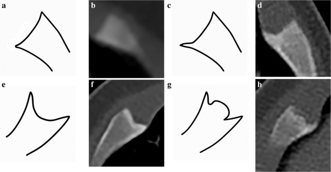 Costochondral junction variations in children younger than 2 years.