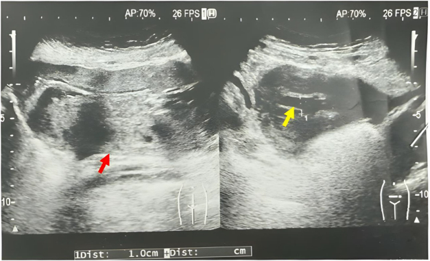 The first case report of chylous ascites in a twin pregnancy following <i>in vitro</i> fertilization: a case report of chylous ascites in twin pregnancy.