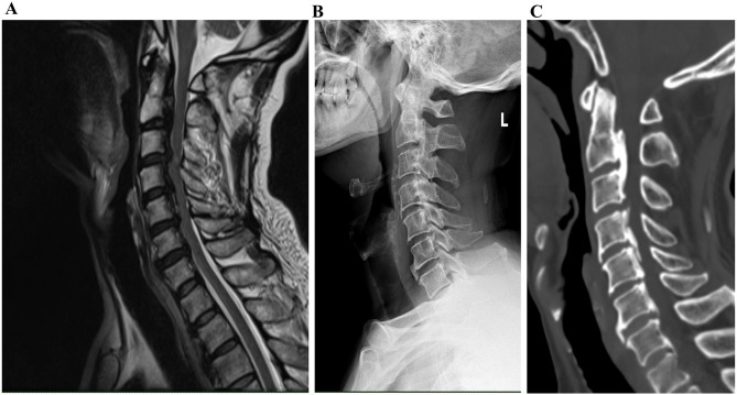 Viral-Induced Erythema Multiforme Complicated by Secondary Bacterial Infection with Hyperpyrexia Following Cervical Spine Surgery: A Rare Case of Dual Infection.