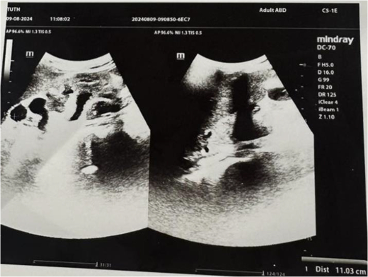 A rare case of advanced CKD with extensive cystic renal disease causing bowel obstruction.
