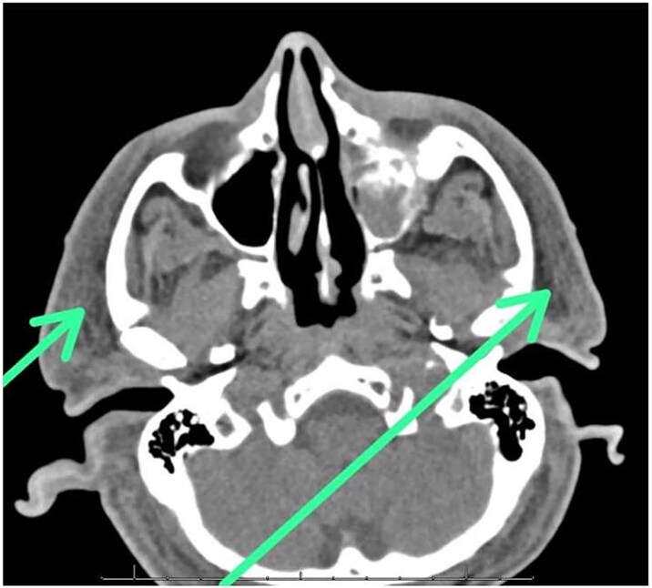 Fatal facial necrotizing fasciitis: a case report highlighting diagnostic and therapeutic challenges.