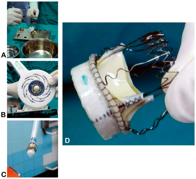 Comparison of Surgical Treatment Outcomes in Patients with Symptomatic Severe Aortic Valve Stenosis Using the Perceval Sutureless Bioprosthesis Versus a Conventional Biological Valve.