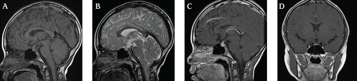 Diagnosis of Lymphocytic Infundibuloneurohypophysitis After Positive Anti-rabphilin-3A Antibody Test in an 8-year-old Boy with Early-onset Central Diabetes Insipidus