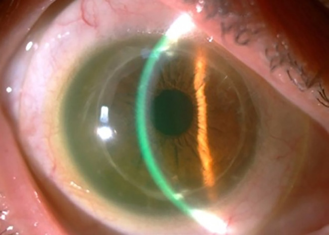 Spectrum of Scleral Lens Fit and Patient Compliance: A Single Center Retrospective Study.