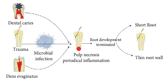 Effect of Oral Pathogens Associated With Pulpitis and Apical Periodontitis on Odontogenic Mesenchymal Stem Cells.