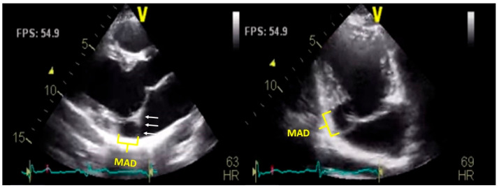 Mitral Annular Disjunction: Epidemiology, Diagnostic Methods, Prognosis, and Novel Implications.
