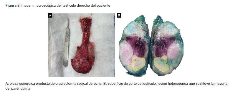 [Primary testicular lymphoma with extranodal involvement in the stomach. Case report].