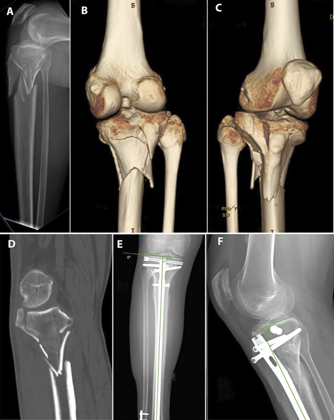 Residual radiographic fracture displacement in healed tibial plateau fractures: comparison after treatment with suprapatellar nailing versus lateral plating.