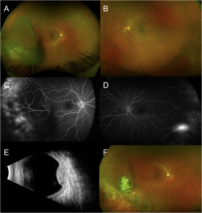 Clinical Characteristics and Treatment Outcomes of Breakthrough Vitreous Hemorrhage in Peripheral Exudative Hemorrhagic Chorioretinopathy (PEHCR).