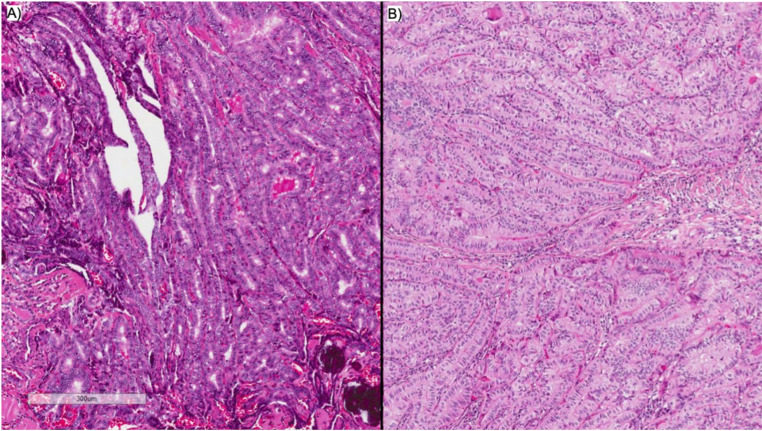 Biochemical and structural response in patients with tall cell papillary thyroid cancer: a dual centre retrospective study : Early Recurrence in Tall Cell PTC.