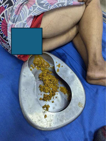 A Rare Case Report on Bowel Obstruction due to Seed Bezoar at the Rectum.