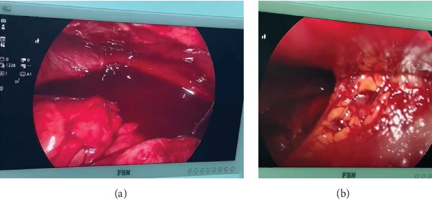 Unexpected Acute-Onset Stump Appendicitis in a Teenager: A Rare Postappendectomy Complication.