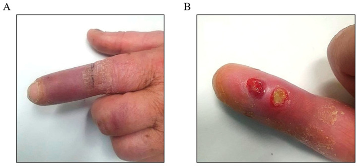 The First <i>Schaalia</i> (Formerly <i>Actinomyces</i>) <i>Canis</i>-Related Osteomyelitis Requiring Surgical Intervention.