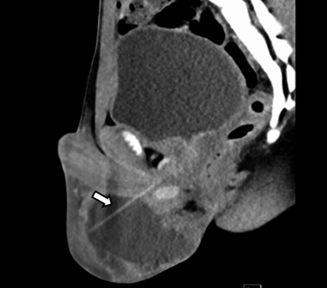 Migration of a urethral foreign body into the scrotum in an adolescent: a case report.