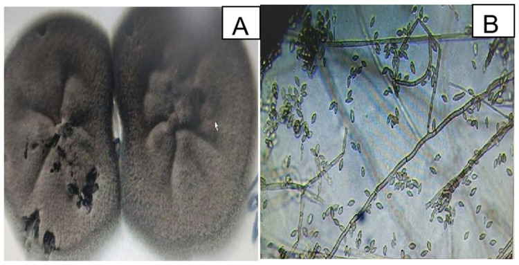 Updates on Current Situation of Cutaneous Sporotrichosis: A Narrative Review.