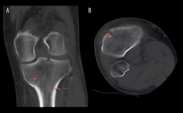 Rapid-Onset Venous Thrombosis After Tibia Fracture: A Case Report.