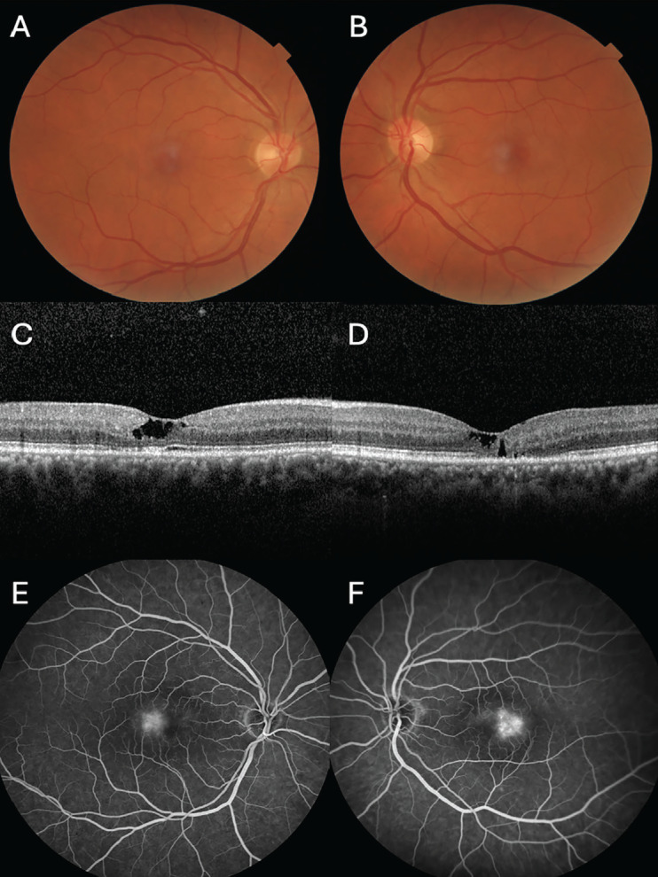 Macular Telangiectasia Type 2: Long-Term Disease Progression and Management of Complications.