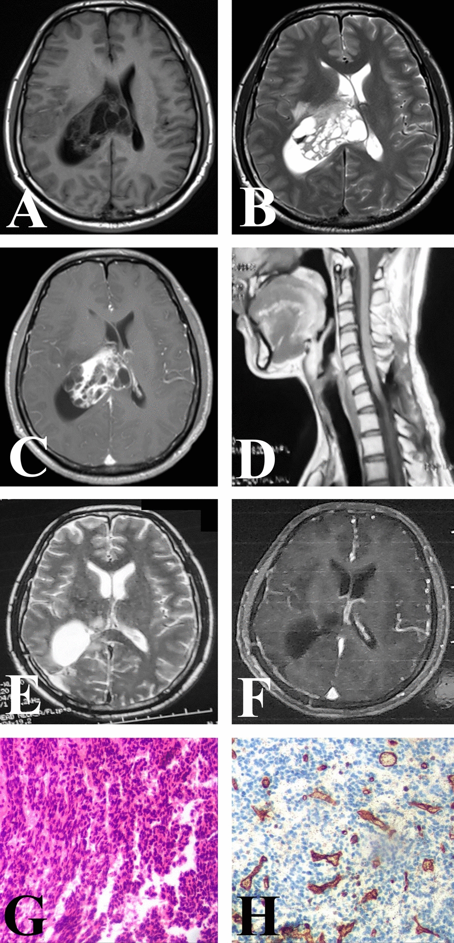 Intraventricular metastasis with malignant progression of an intraspinal solitary fibrous tumor: a case report and review of the literature.