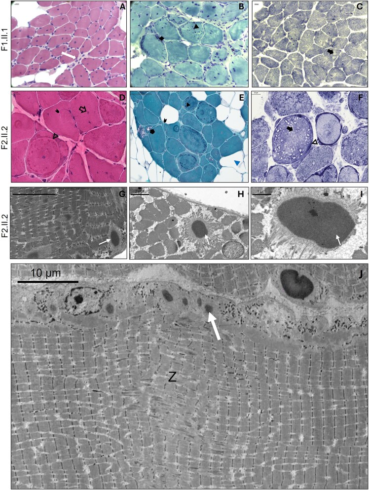 Novel missense variants in CFL2 affect F-actin depolymerisation and expand the disease spectrum of CFL2-related myopathy.