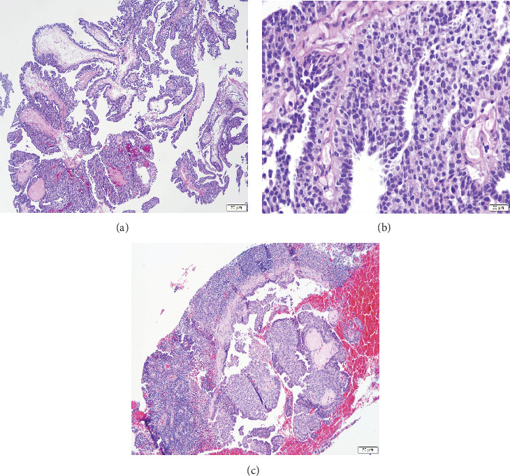 An Advanced-Stage Encapsulated Papillary Breast Carcinoma in a Male: A Case Report.
