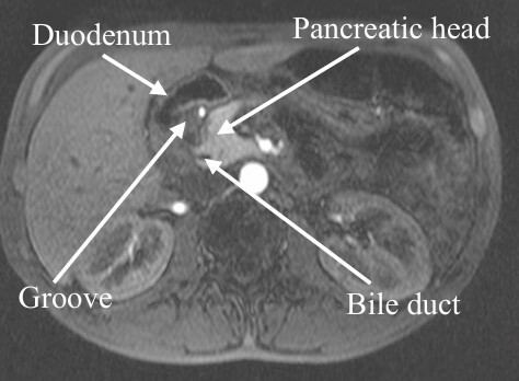 Pancreatoduodenectomy and surgical treatment of groove pancreatitis.