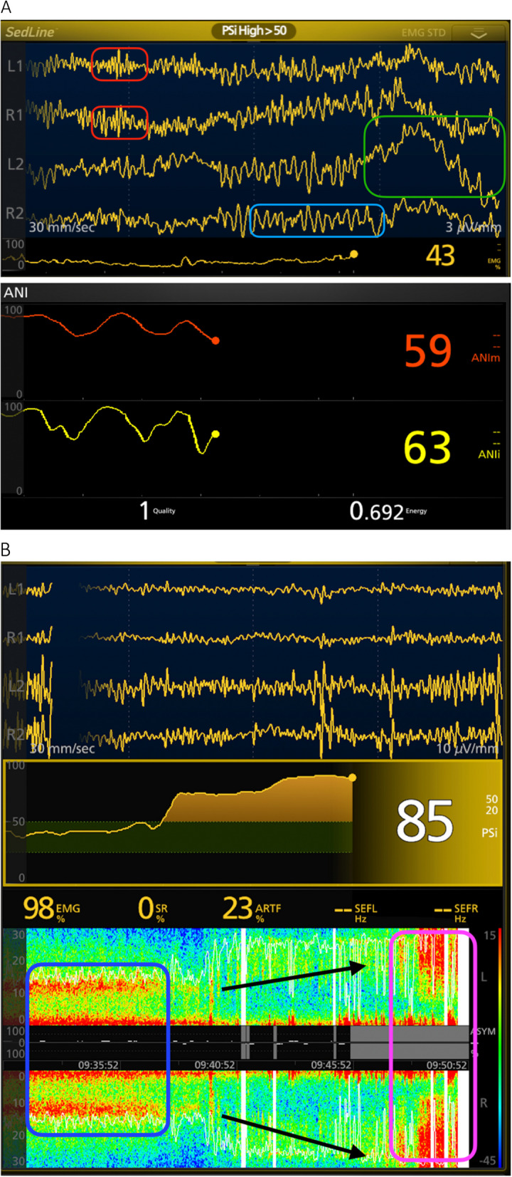 Multimodal sedation guided by processed electroencephalography and autonomic nervous system monitoring for spinal cord stimulator implantation: retrospective identification of anesthetic drug doses.