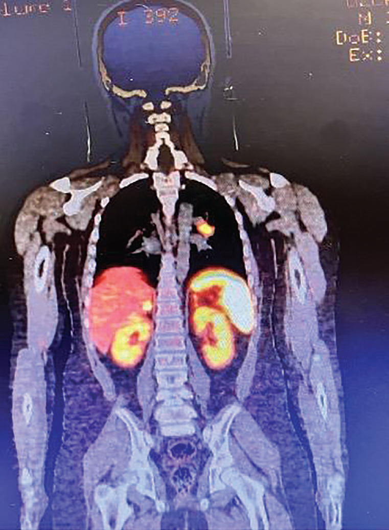 A Challenging Case of Ectopic Adrenocorticotropin Hormone Syndrome with Bronchial Carcinoid and Literature Review