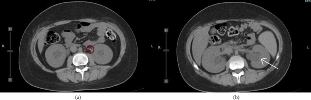 Bilateral Ureteral Lithiasis and Postrenal Acute Kidney Injury: A Rare Complication of Diabetic Ketoacidosis in a Child.