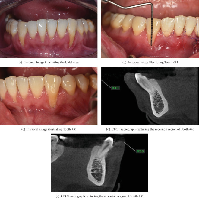Modified Rotated Flap With Double-Component Releasing Incision and One-Sided Tunnel for Mandibular Gingival Recession: A Case Report.