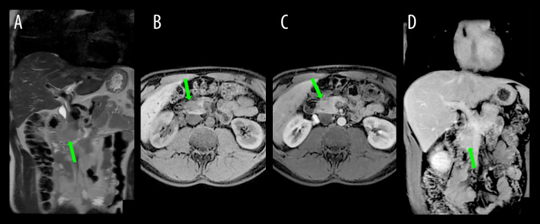 Pancreatic Inflammation Induced by Immune Checkpoint Inhibitors in Melanoma Treatment: A Case Report.