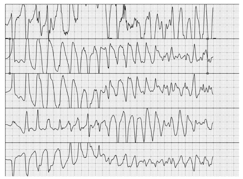 Management of Malignant Arrhythmia in Apical Hypertrophic Cardiomyopathy: A Case Report.