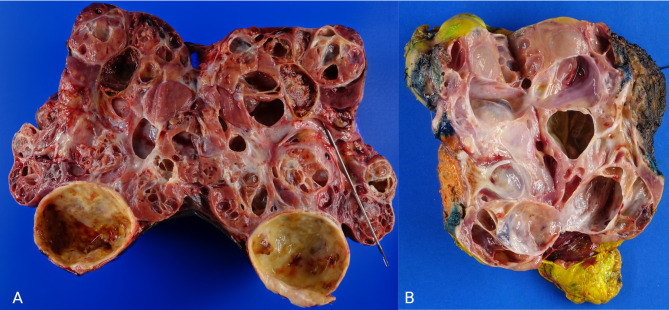 Bilateral, multicystic fumarate hydratase-deficient renal cell carcinoma in patient with hereditary leiomyomatosis & renal cell carcinoma syndrome: A case report and review of the literature.