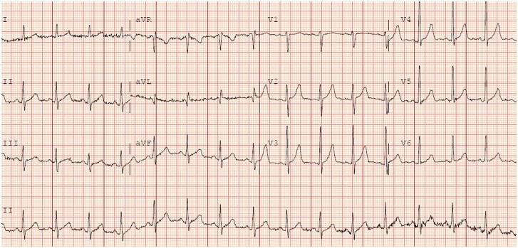 A case report of fulminant eosinophilic myo-pericarditis related to checkpoint inhibitors complicated by acute heart failure and cardiac tamponade.