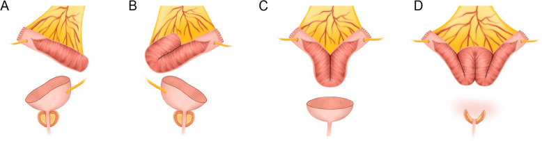Clinical outcomes of neobladder or augmentation after cystectomy in locally advanced colorectal cancer involving urinary tract: case series.