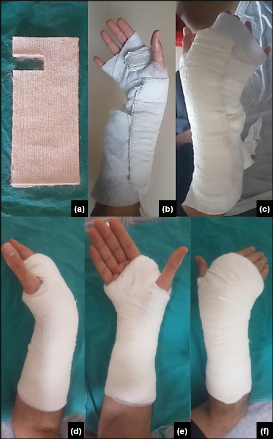 Dorsoradial vs. circular cast for distal radius fractures: a retrospective comparative cohort study.