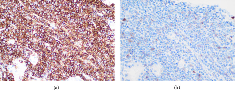 A Rare Case of Renal Failure Caused by T-Cell Prolymphocytic Leukaemia Infiltration.