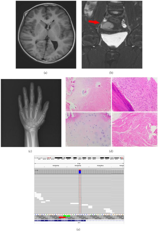 A Case of Proteus Syndrome, Suspected as Maffucci Syndrome in a Chinese Child.
