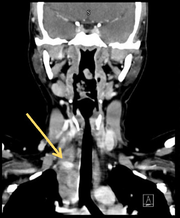Beyond the Lungs: A Rare Case of Extrapulmonary Tuberculosis Presenting With Neck Vein Thrombosis and Seizure.