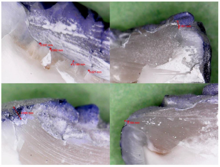 Comparative in Vitro Evaluation of Marginal Sealing in Class I Composite Restorations Using Fifth- and Seventh-Generation Adhesives.