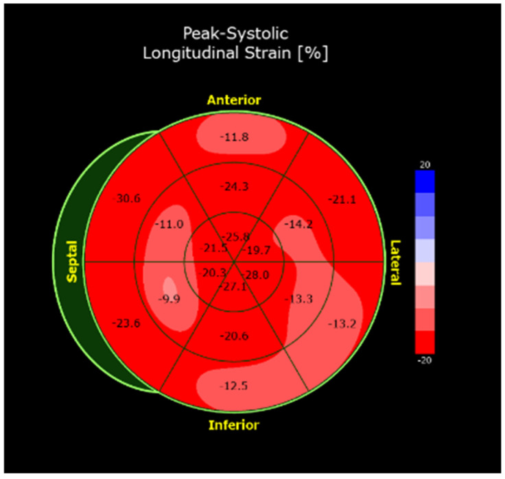 Multimodality Imaging in Eosinophilic Myocarditis: A Rare Cause of Heart Failure.