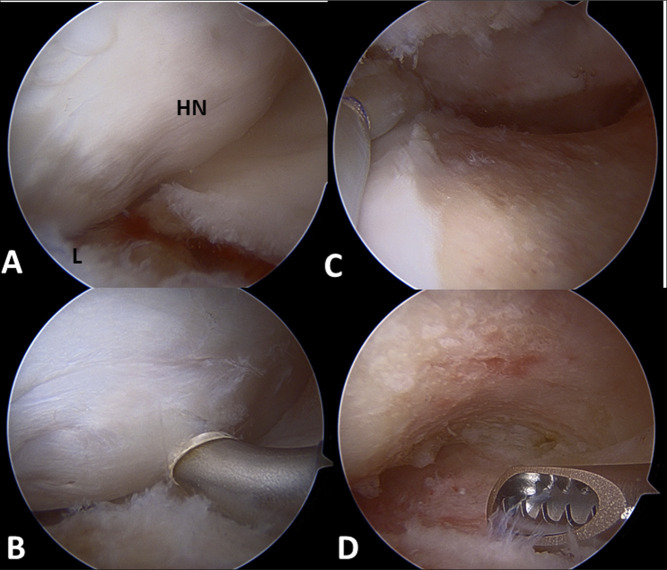 Contemporary Techniques in Femoral Osteoplasty.