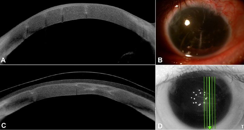 Spectrum of Scleral Lens Fit and Patient Compliance: A Single Center Retrospective Study.