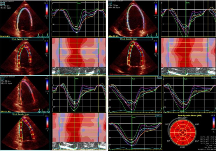 Reliability of left ventricular global longitudinal strain across acquisition and analysis techniques: a prospective comparative study.