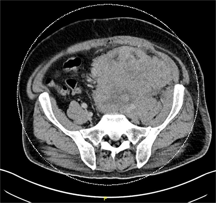 Atypical presentation of Merkel cell carcinoma with pulmonary embolism.