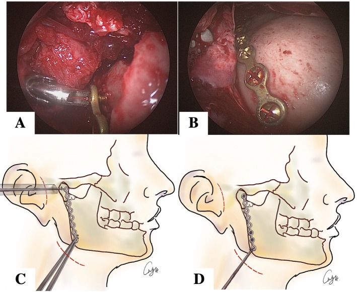 Novel Endoscopic-Assisted Long Plate Approach for Mandibular Condylar Fracture Reconstruction-A Preliminary Study.