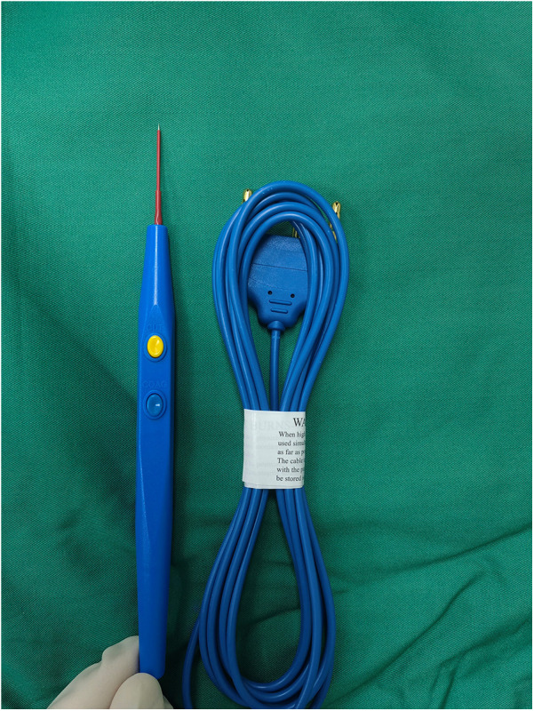 Clinical observation of transurethral reconstruction of urethral meatus and navicularis fossa short strictures with annular inlay oral mucosa graft urethroplasty.