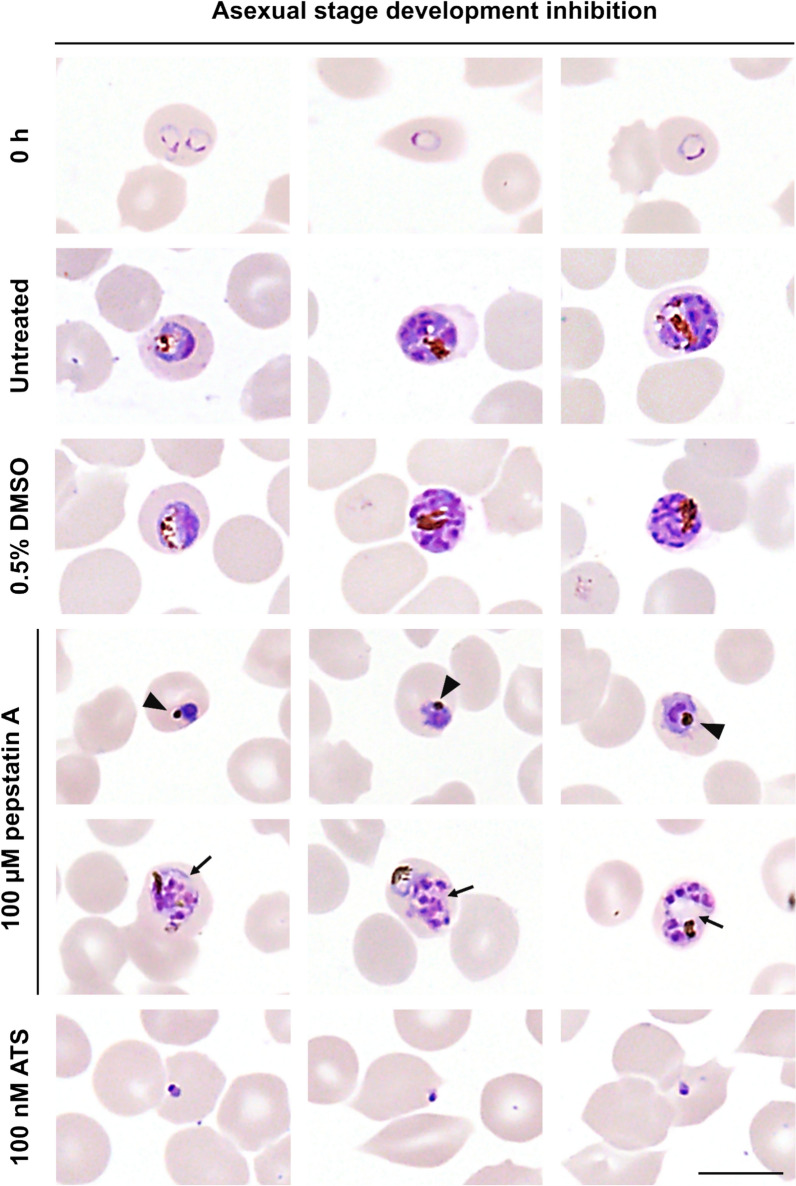 Aspartyl protease inhibition interferes with Plasmodium falciparum asexual blood-stage and early gametocyte development.