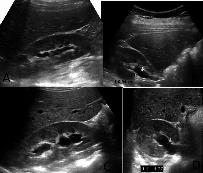 Hydration-induced hydronephrosis in healthy adults: a diagnostic pitfall in renal ultrasound imaging.