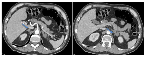 Addison's disease due to adrenal insufficiency in an immunocompetent patient with disseminated cryptococcosis. Case report.